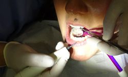 Endodonti Uzmanı: Kanal tedavisiyle diş çekimi önlenebilir