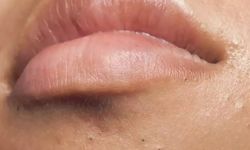 Perioral Dermatit nedir, nasıl tedavi edilir?