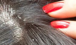 Saç derisi kaşıntısını hafifletmenin yolları nelerdir?