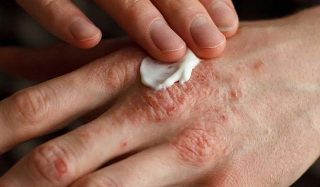 Egzama Nedir? Neden Olur, Egzamaya Ne İyi Gelir?