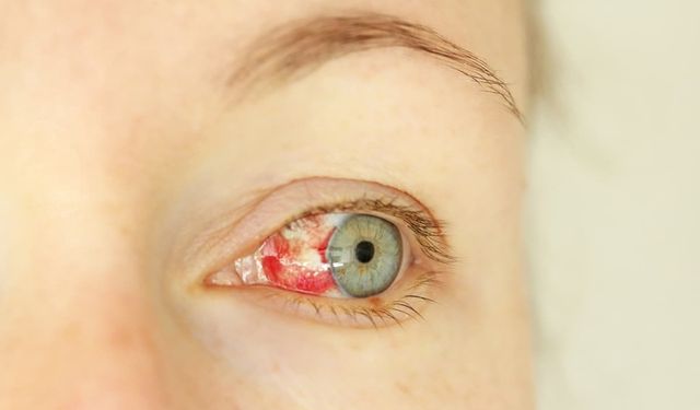 DSÖ uyardı: Gözünüzde kanama varsa dikkat! binlerce kişi öldü