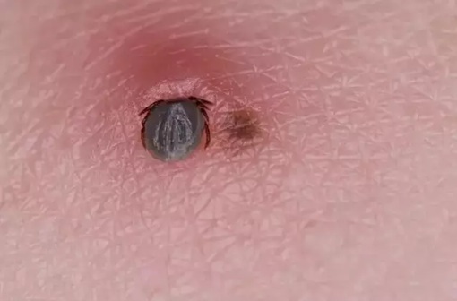 Kene Hastalığı Tedavileri 1