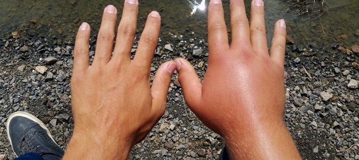 Arı Sokması Belirti Önlem 2